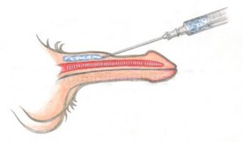 Volumizáló hialuronsav injekció a péniszbe